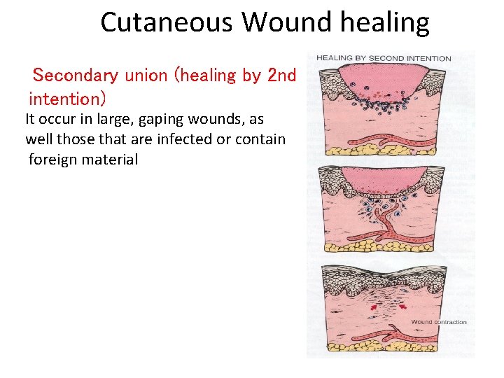 Cutaneous Wound healing Secondary union (healing by 2 nd intention) It occur in large,