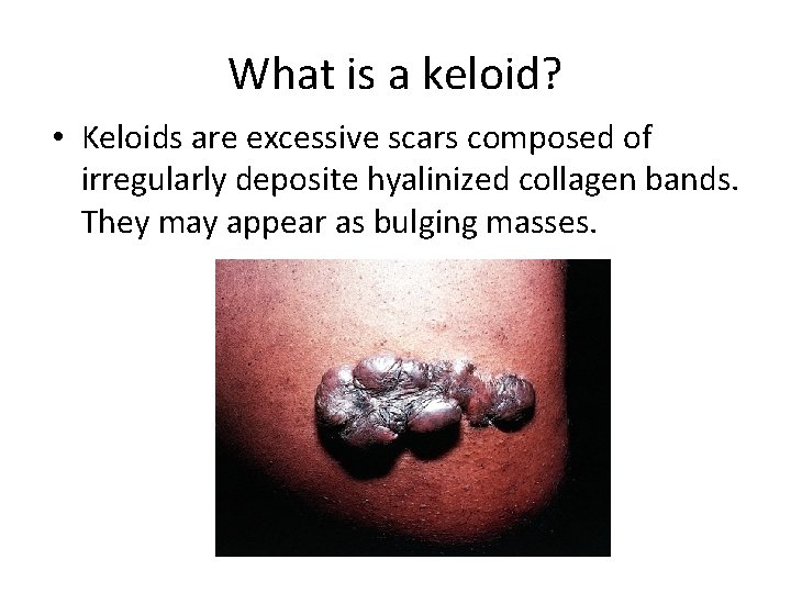 What is a keloid? • Keloids are excessive scars composed of irregularly deposite hyalinized