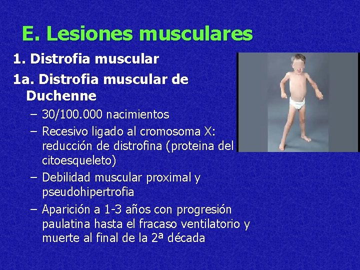 E. Lesiones musculares 1. Distrofia muscular 1 a. Distrofia muscular de Duchenne – 30/100.