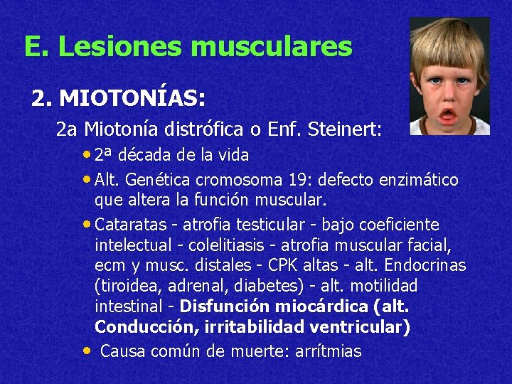 E. Lesiones musculares 2. MIOTONÍAS: 2 a Miotonía distrófica o Enf. Steinert: • 2ª