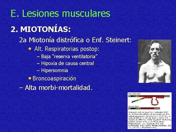 E. Lesiones musculares 2. MIOTONÍAS: 2 a Miotonía distrófica o Enf. Steinert: • Alt.