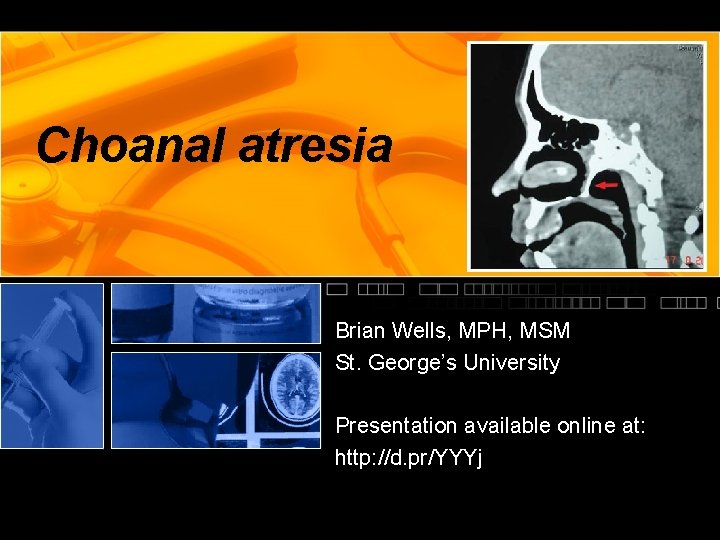 Choanal atresia Brian Wells, MPH, MSM St. George’s University Presentation available online at: http: