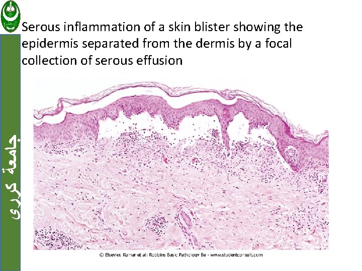  ﺟﺎﻣﻌﺔ ﻛﺮﺭﻱ Serous inflammation of a skin blister showing the epidermis separated from