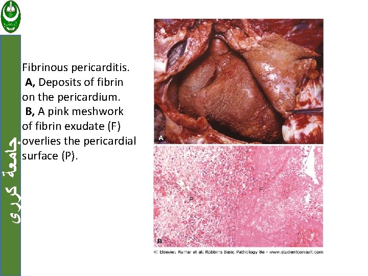  ﺟﺎﻣﻌﺔ ﻛﺮﺭﻱ Fibrinous pericarditis. A, Deposits of fibrin on the pericardium. B, A