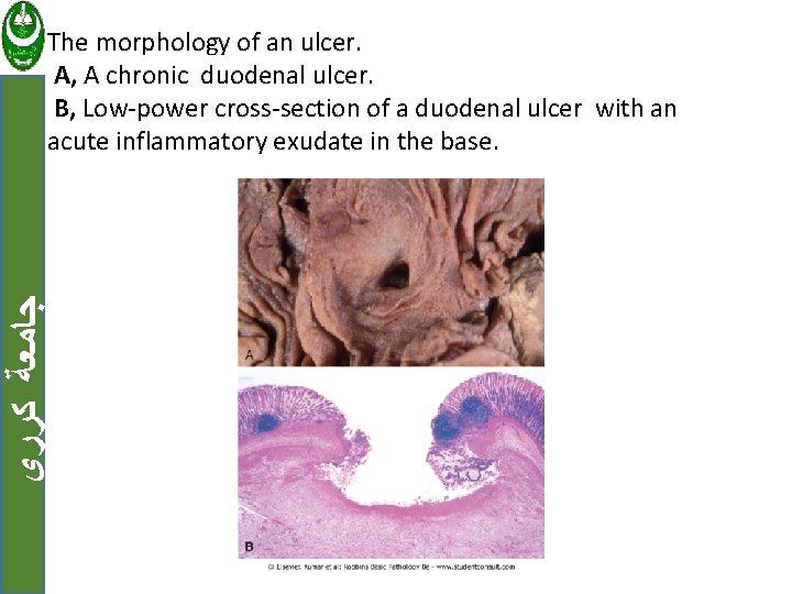  ﺟﺎﻣﻌﺔ ﻛﺮﺭﻱ The morphology of an ulcer. A, A chronic duodenal ulcer. B,