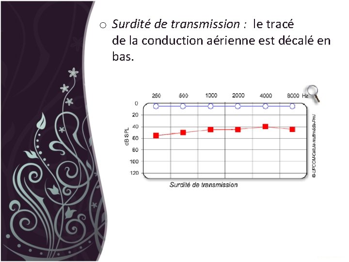 o Surdité de transmission : le tracé de la conduction aérienne est décalé en