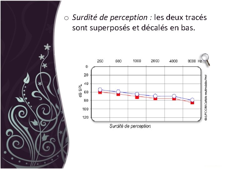 o Surdité de perception : les deux tracés sont superposés et décalés en bas.