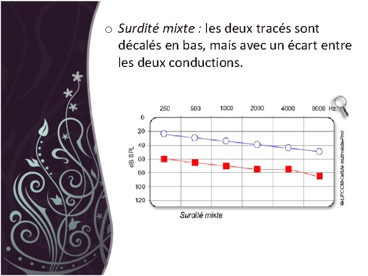 o Surdité mixte : les deux tracés sont décalés en bas, mais avec un