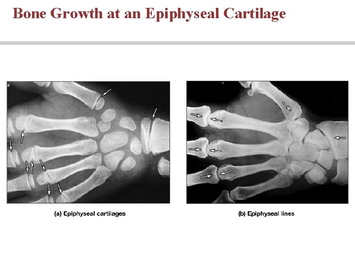 Bone Growth at an Epiphyseal Cartilage 