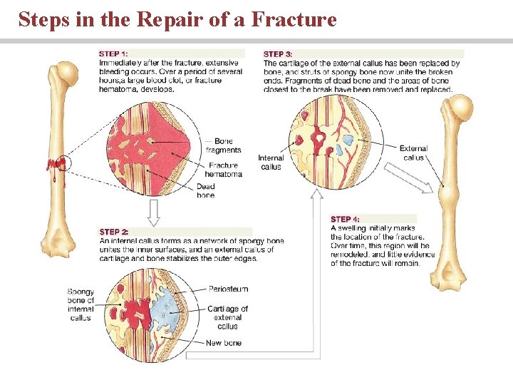 Steps in the Repair of a Fracture 