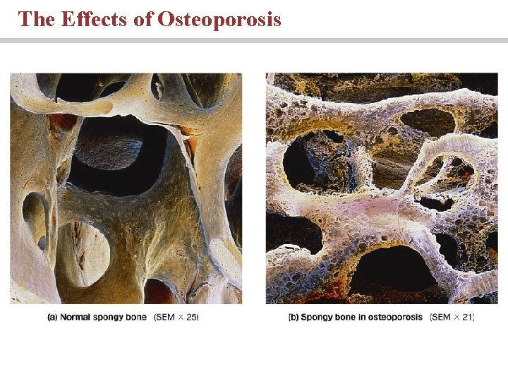 The Effects of Osteoporosis 