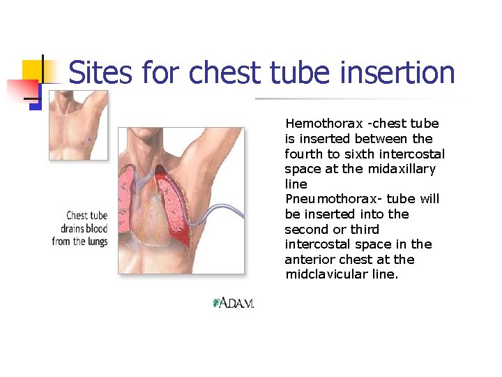 Sites for chest tube insertion Hemothorax -chest tube is inserted between the fourth to