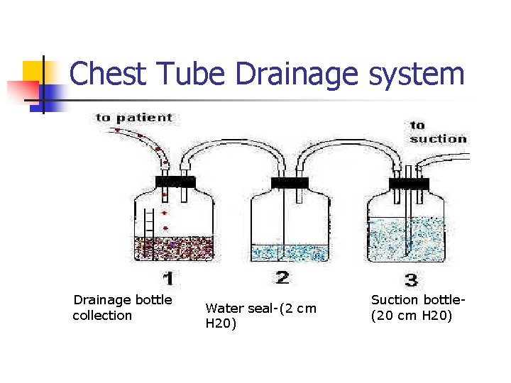 Chest Tube Drainage system Drainage bottle collection Water seal-(2 cm H 20) Suction bottle(20