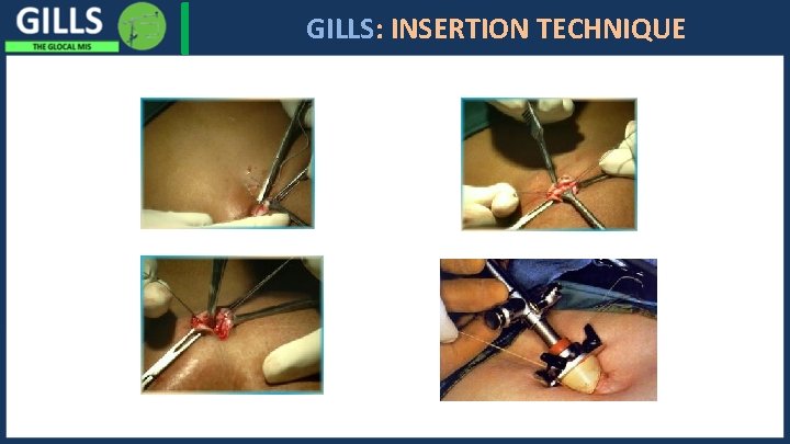 I GILLS: INSERTION TECHNIQUE 