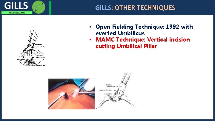 I GILLS: OTHER TECHNIQUES § Open Fielding Technique: 1992 with everted Umbilicus § MAMC