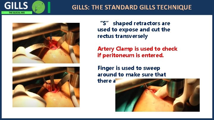 I GILLS: THE STANDARD GILLS TECHNIQUE “S” shaped retractors are used to expose and