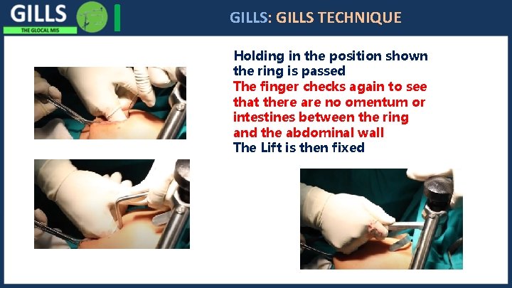 I GILLS: GILLS TECHNIQUE Holding in the position shown the ring is passed The