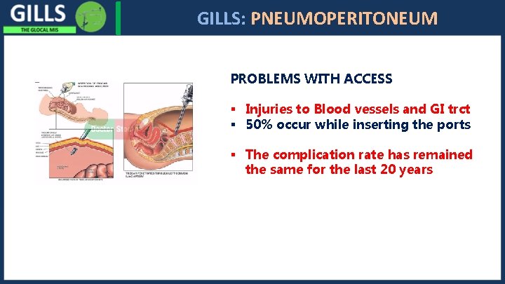 I GILLS: PNEUMOPERITONEUM PROBLEMS WITH ACCESS § Injuries to Blood vessels and GI trct
