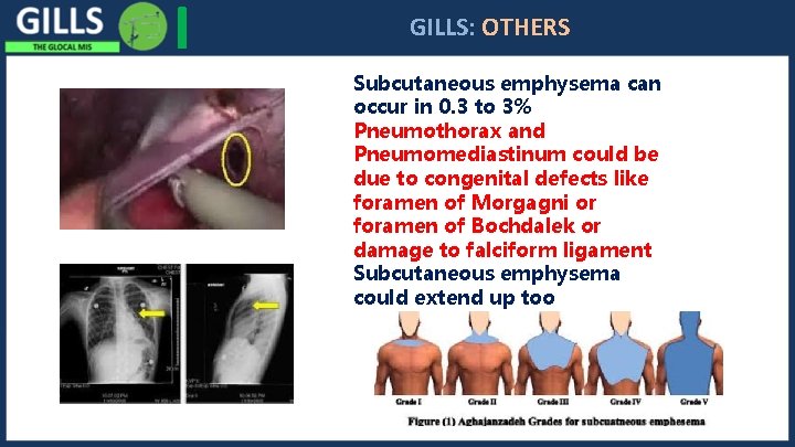 I GILLS: OTHERS Subcutaneous emphysema can occur in 0. 3 to 3% Pneumothorax and