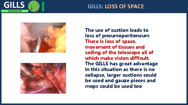 I GILLS: LOSS OF SPACE The use of suction leads to loss of pneumoperitoneum
