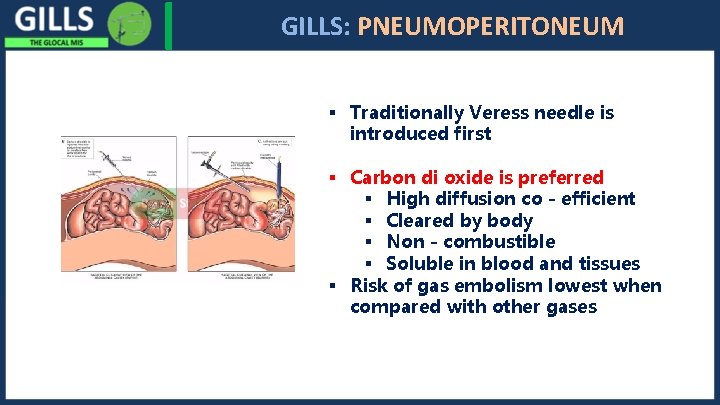 I GILLS: PNEUMOPERITONEUM § Traditionally Veress needle is introduced first § Carbon di oxide