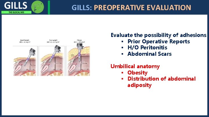 I GILLS: PREOPERATIVE EVALUATION Evaluate the possibility of adhesions § Prior Operative Reports §