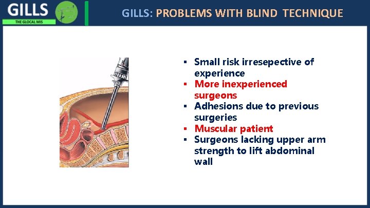 I GILLS: PROBLEMS WITH BLIND TECHNIQUE § Small risk irresepective of experience § More