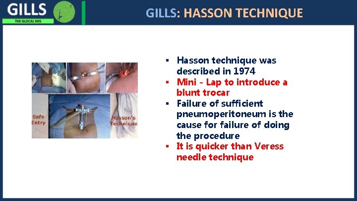 I GILLS: HASSON TECHNIQUE § Hasson technique was described in 1974 § Mini -