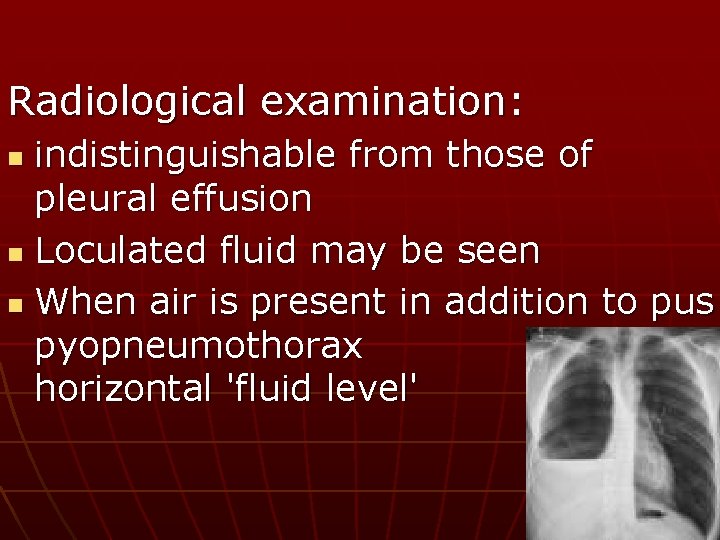 Radiological examination: indistinguishable from those of pleural effusion n Loculated fluid may be seen
