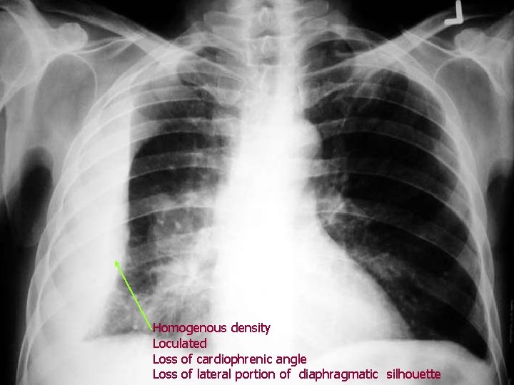 Homogenous density Loculated Loss of cardiophrenic angle Loss of lateral portion of diaphragmatic silhouette