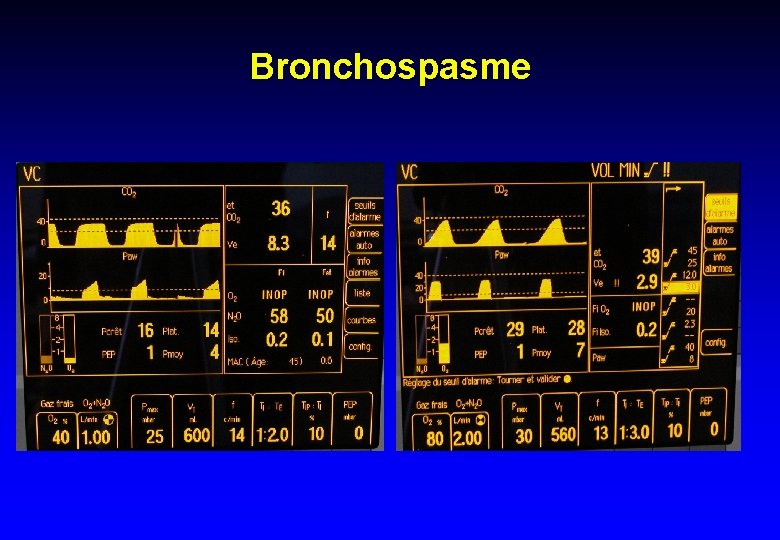 Bronchospasme 