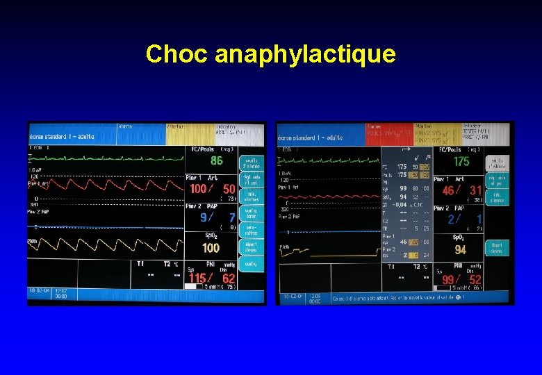 Choc anaphylactique 