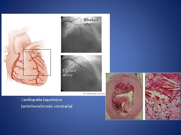 Cardiopatía isquémica (arterioesclerosis coronaria) 