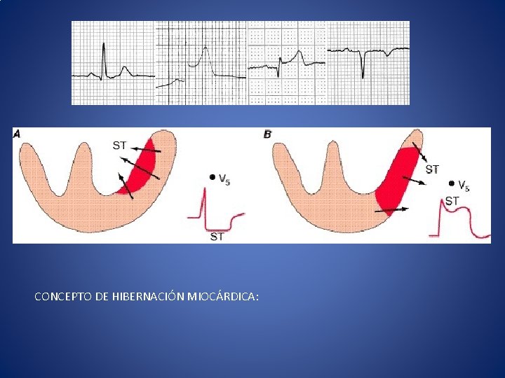 CONCEPTO DE HIBERNACIÓN MIOCÁRDICA: 