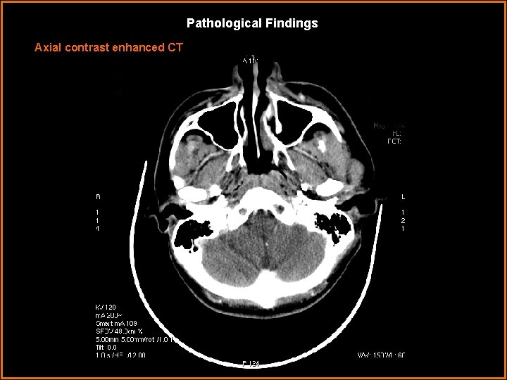 Pathological Findings Axial contrast enhanced CT 