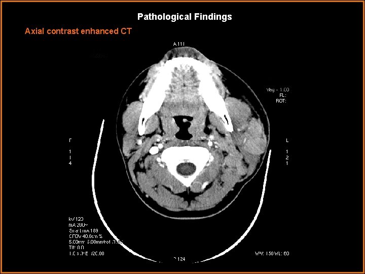 Pathological Findings Axial contrast enhanced CT 