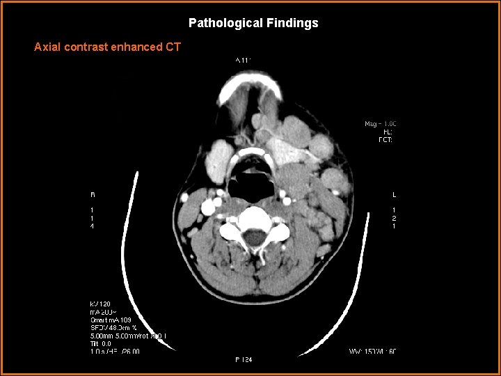 Pathological Findings Axial contrast enhanced CT 