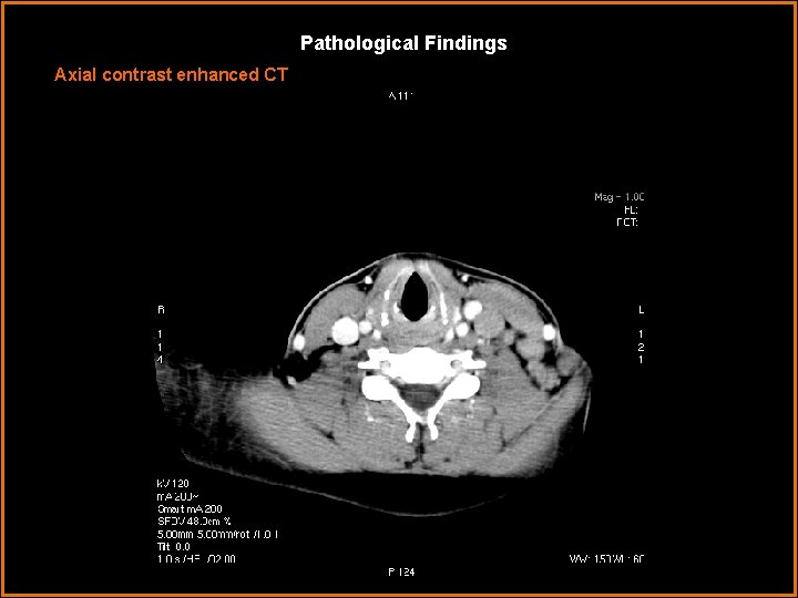 Pathological Findings Axial contrast enhanced CT 