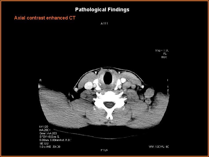 Pathological Findings Axial contrast enhanced CT 