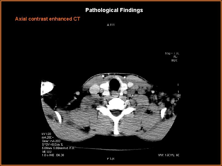 Pathological Findings Axial contrast enhanced CT 