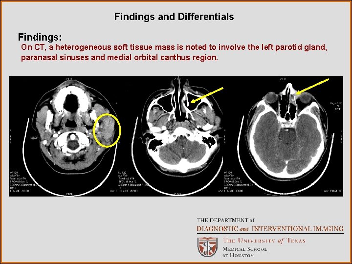 Findings and Differentials Findings: On CT, a heterogeneous soft tissue mass is noted to