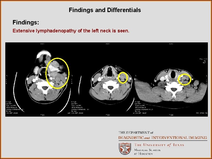 Findings and Differentials Findings: Extensive lymphadenopathy of the left neck is seen. 