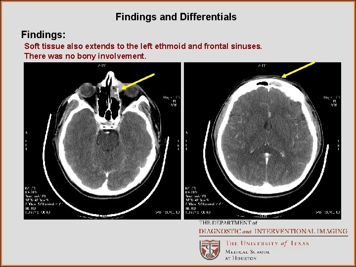 Findings and Differentials Findings: Soft tissue also extends to the left ethmoid and frontal
