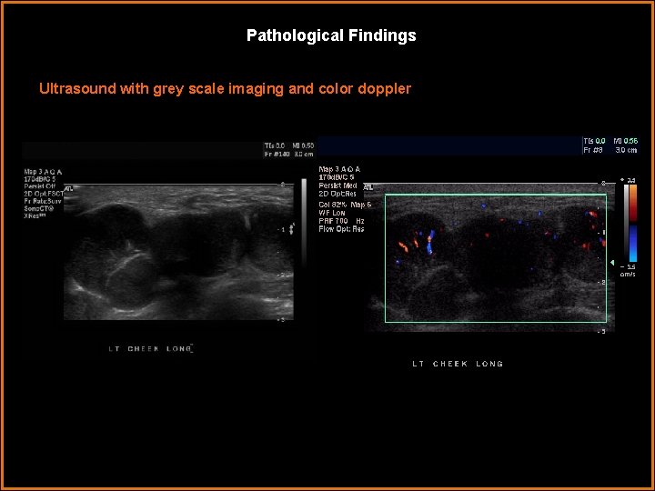 Pathological Findings Ultrasound with grey scale imaging and color doppler 