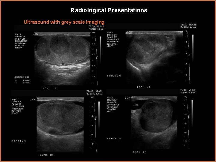 Radiological Presentations Ultrasound with grey scale imaging 