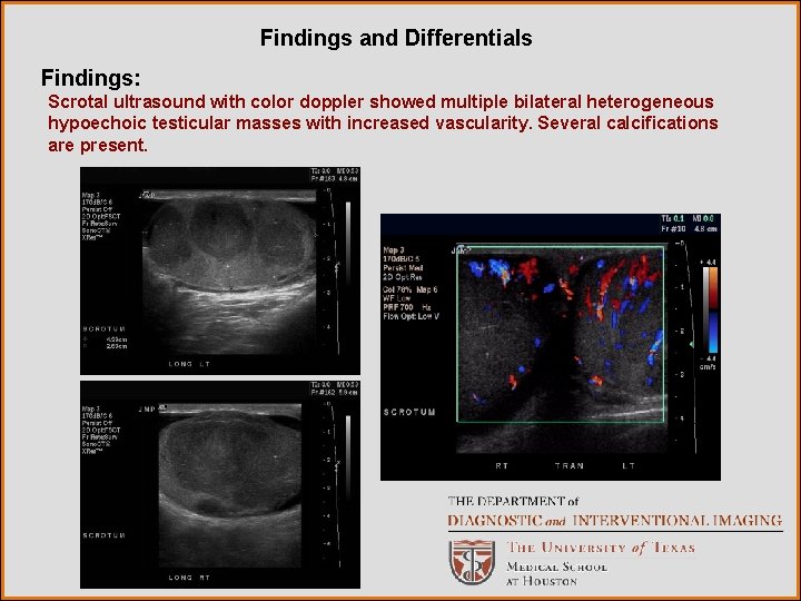 Findings and Differentials Findings: Scrotal ultrasound with color doppler showed multiple bilateral heterogeneous hypoechoic