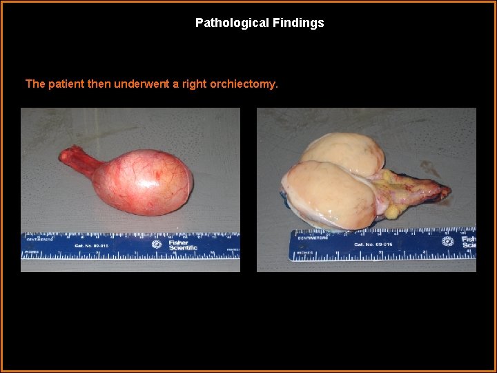 Pathological Findings The patient then underwent a right orchiectomy. 