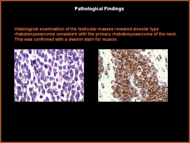Pathological Findings Histological examination of the testicular masses revealed alveolar type rhabdomyosarcoma consistent with
