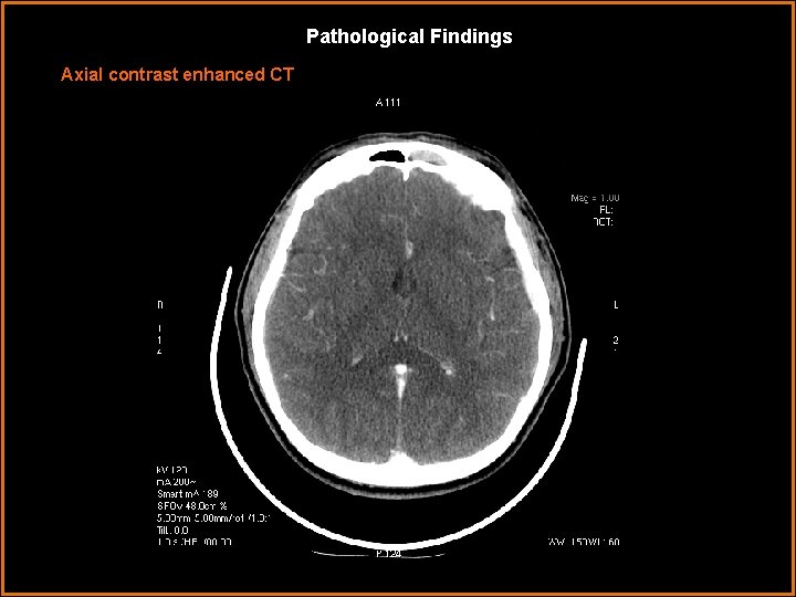 Pathological Findings Axial contrast enhanced CT 