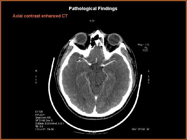 Pathological Findings Axial contrast enhanced CT 